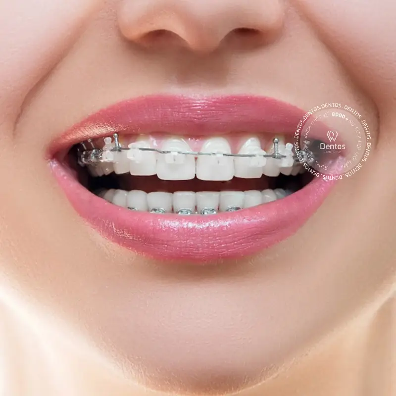 Sau niềng, bạn có thể cân nhắc dán veneer để hoàn thiện thêm màu sắc/dáng răng